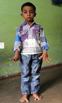 印度4歲男童患病長(zhǎng)13根手指和12個(gè)腳趾(圖)
