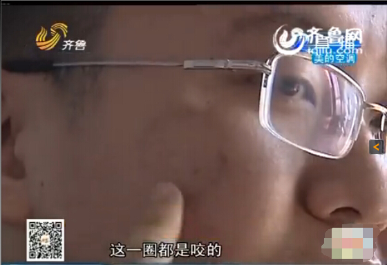 東營(yíng)：男子與同事辦公室打架被咬臉 對(duì)方拒絕賠償