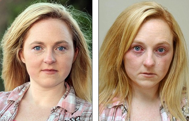 哭能致命！ 英國女子皮膚對水嚴(yán)重過敏不敢流淚