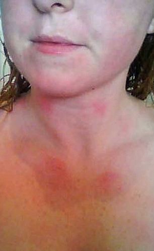 哭能致命！ 英國女子皮膚對水嚴(yán)重過敏不敢流淚