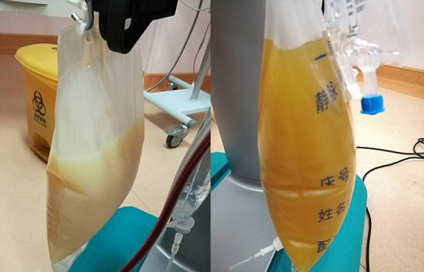 中山男子腹痛緊急送醫(yī)搶救，檢出“牛奶血”！
